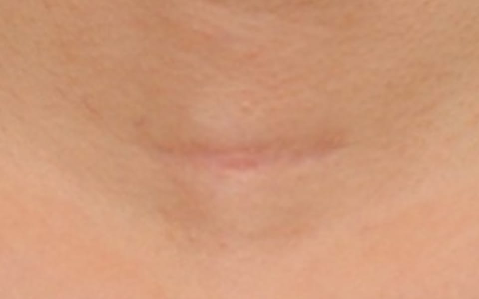 scar-treatment-after-before